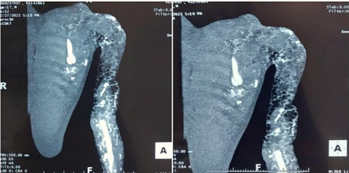 La tomografía computarizada multicorte muestra que el ala izquierda del paciente presenta una depresión similar a un panal. Foto: Proporcionada por el hospital.