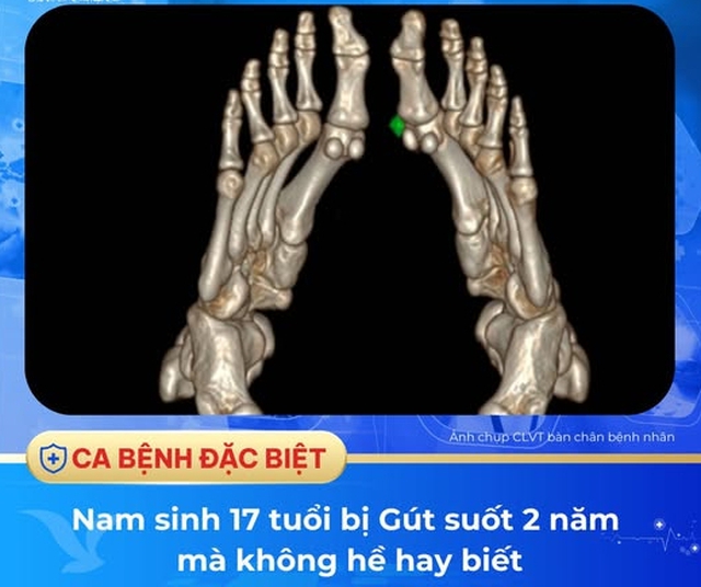 Bất ngờ nam sinh 17 tuổi ở Hà Nội mắc bệnh Gút suốt 2 năm mà không hề hay biết - Ảnh 2.