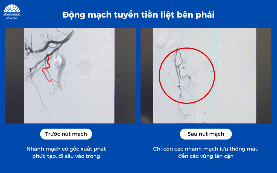 Hình ảnh động mạch tuyến tiền liệt bên phải trước và sau khi can thiệp.