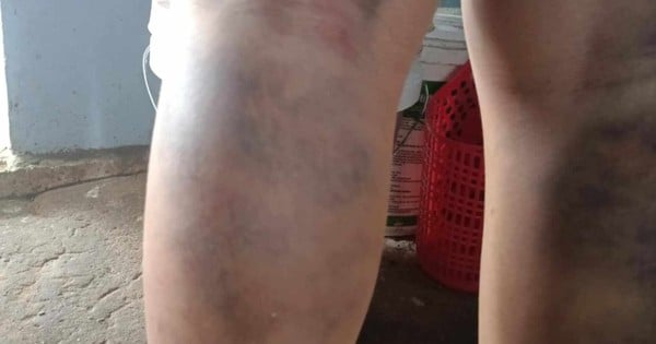 Temporarily suspend teacher who beat student, causing bruising on both legs