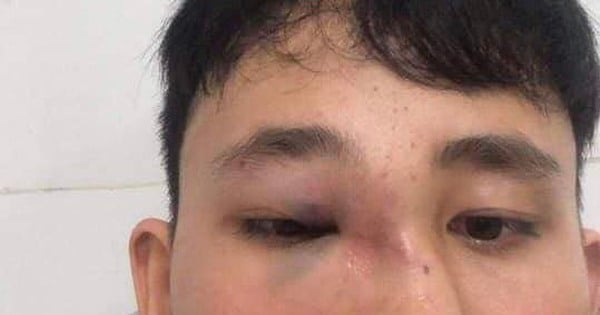 10th grade student suffered a broken nose after school violence