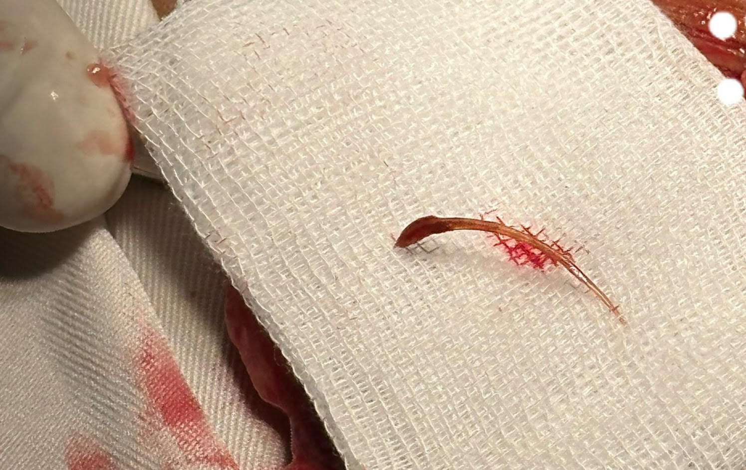 Một bệnh nhân ở Long An nuốt xương cá xuống ruột thừa, gây viêm nhiễm - Ảnh 1.