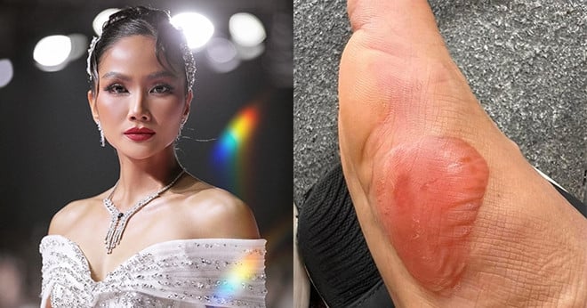 Swollen legs, H'Hen Nie suppresses pain to confidently catwalk