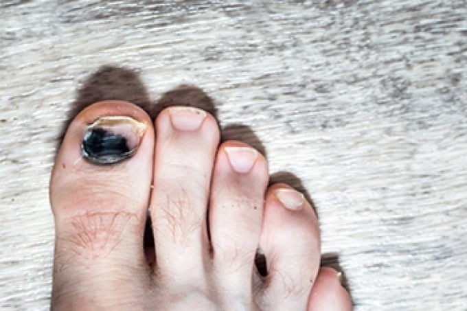 Abnormal black toenails can warn of dangerous diseases. Photo: Verywell
