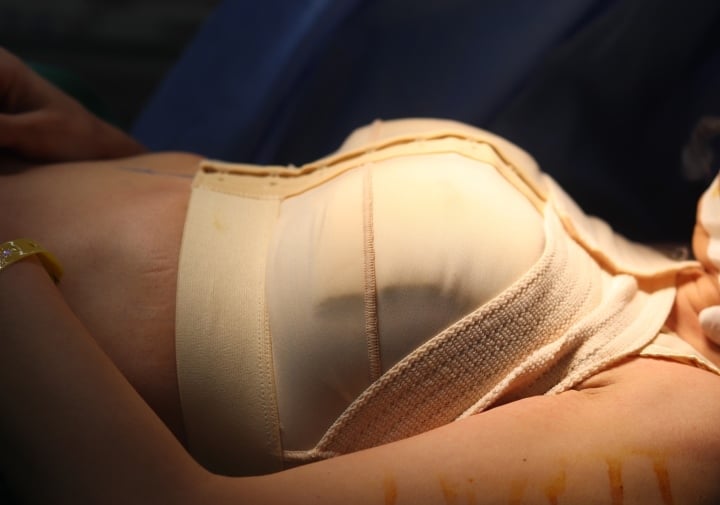 Breast gap after breast augmentation, what is the cause? - 5