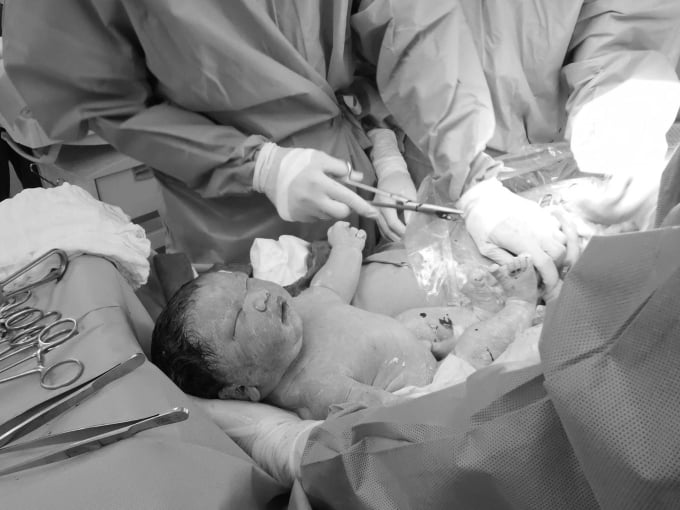 外科チームは5キロの男の赤ちゃんを母親の子宮から取り出した。写真：Tue Diem