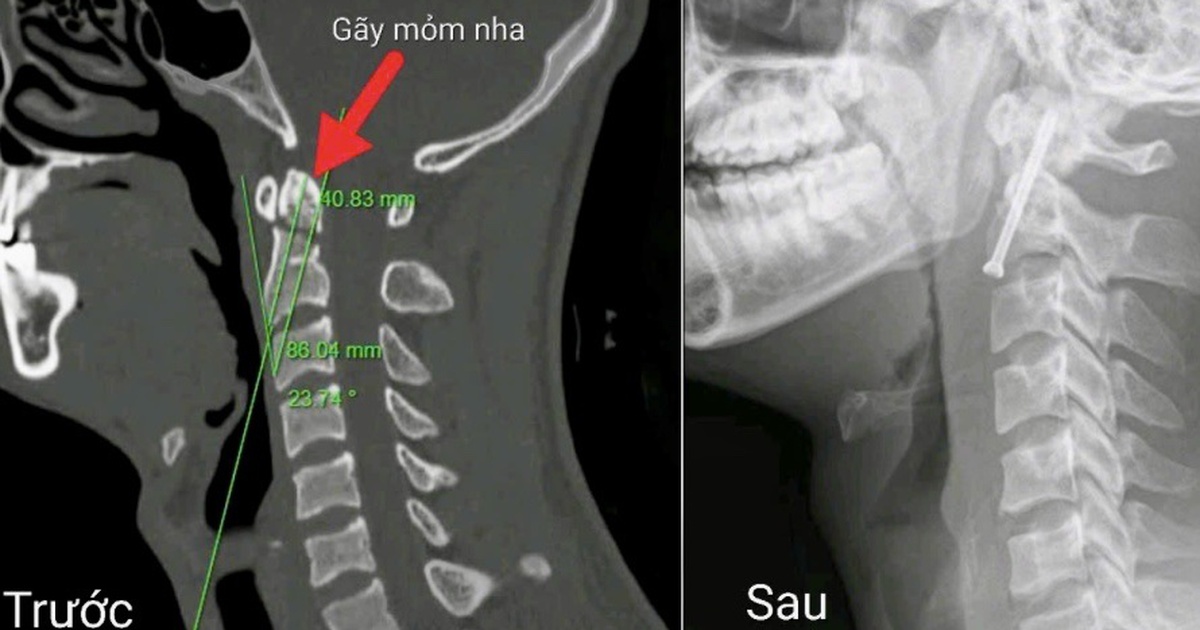 Cirugía endoscópica trató con éxito fractura compleja de columna cervical