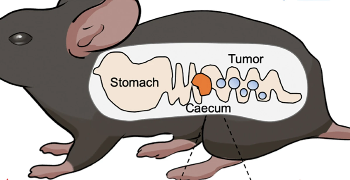 Terapia bacteriana en el tratamiento del cáncer de colon