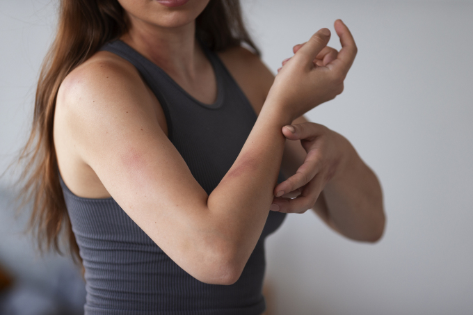 When bitten by a mosquito, avoid scratching too much as it can tear the skin, make the wound take longer to heal, and increase the risk of scarring. Photo: Freepik