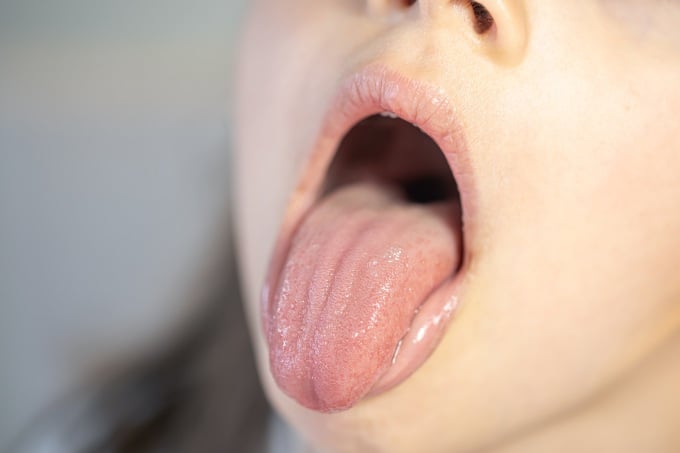 Geschmacksveränderungen weisen auf eine Zungenerkrankung hin. Foto: Freepik