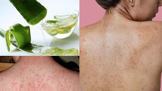 Remedios naturales para las erupciones cutáneas
