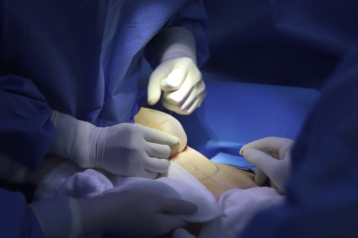 Remove the textured bag during breast implant removal and capsulectomy.