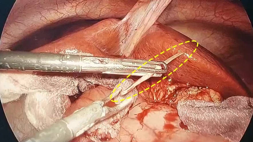 Sau 1 tháng ăn cá, nam thanh niên được phát hiện áp xe tụy do xương cá - Ảnh 1.