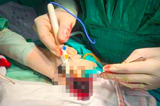 Junger Mann von einer Kuh getreten, ein Hoden musste entfernt werden. Foto 1