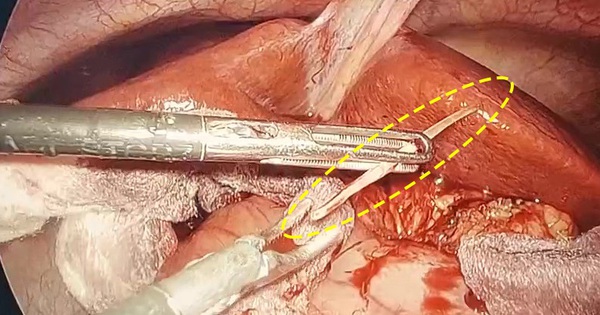 Sau 1 tháng ăn cá, nam thanh niên được phát hiện áp xe tụy do xương cá