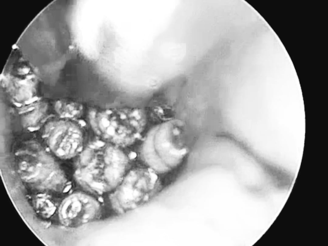 Đau tau dữ dội, đi bệnh viện mới biết có hàng chục con giòi sống bên trong - Ảnh 1.