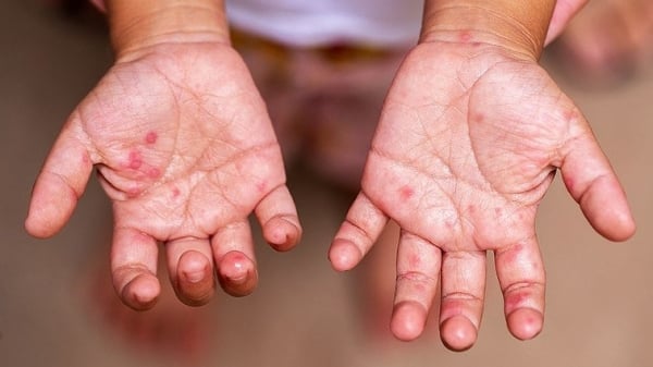 Experts warn of the risk of spreading hand, foot and mouth disease