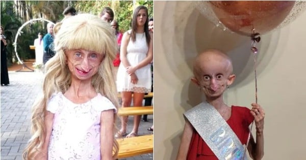 The tragic life of a 19-year-old girl who looks like an old woman