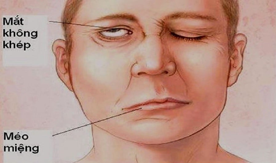 末梢顔面神経麻痺