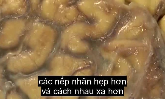 Bệnh Alzheimer tàn phá bộ não như thế nào