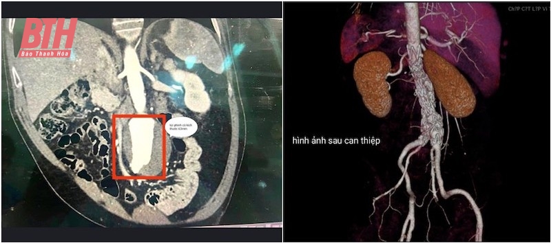 La pose d'un stent sauve la vie d'un patient atteint d'un anévrisme de l'aorte abdominale à risque de rupture