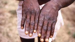 Monkeypox ត្រូវបានចម្លងតាមរយៈទំនាក់ទំនងផ្លូវភេទ និងដំណក់ទឹកធំៗ។