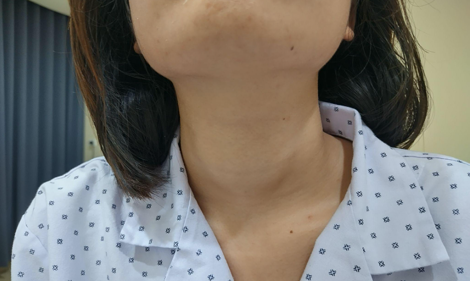 រកឃើញ hyperthyroidism ពីសញ្ញានៃការដកដង្ហើមខ្លី និងចង្វាក់បេះដូងលោតញាប់