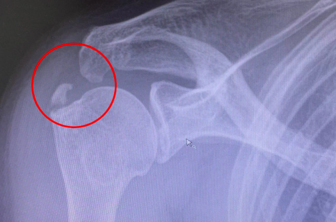 La imagen de la película muestra la tendinitis calcificada del paciente. Foto de : Tam Anh General Hospital