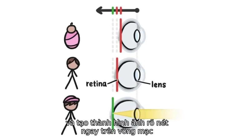 Pourquoi les enfants sont de plus en plus myopes