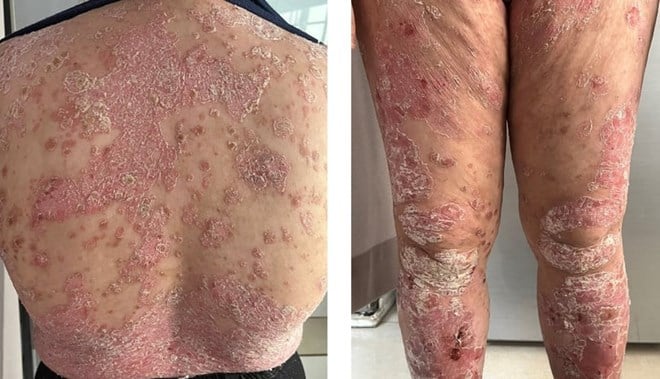 Una joven cae en depresión y esquizofrenia por psoriasis
