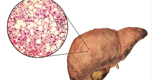 4 điều chỉnh giúp ngăn ngừa gan nhiễm mỡ