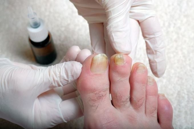 Yellow toenails are a warning sign of nail fungus. Photo: Indian Times