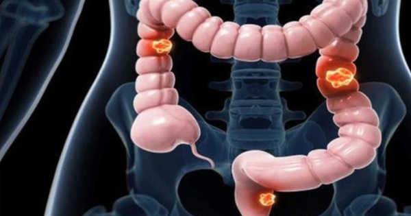 50-year-old man with colon cancer admits to doing this regularly