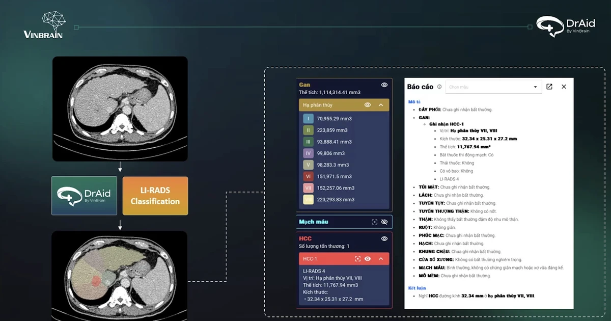 VinBrain hợp tác với Bệnh viện Phổi Trung ương triển khai phần mềm AI trong sàng lọc lao