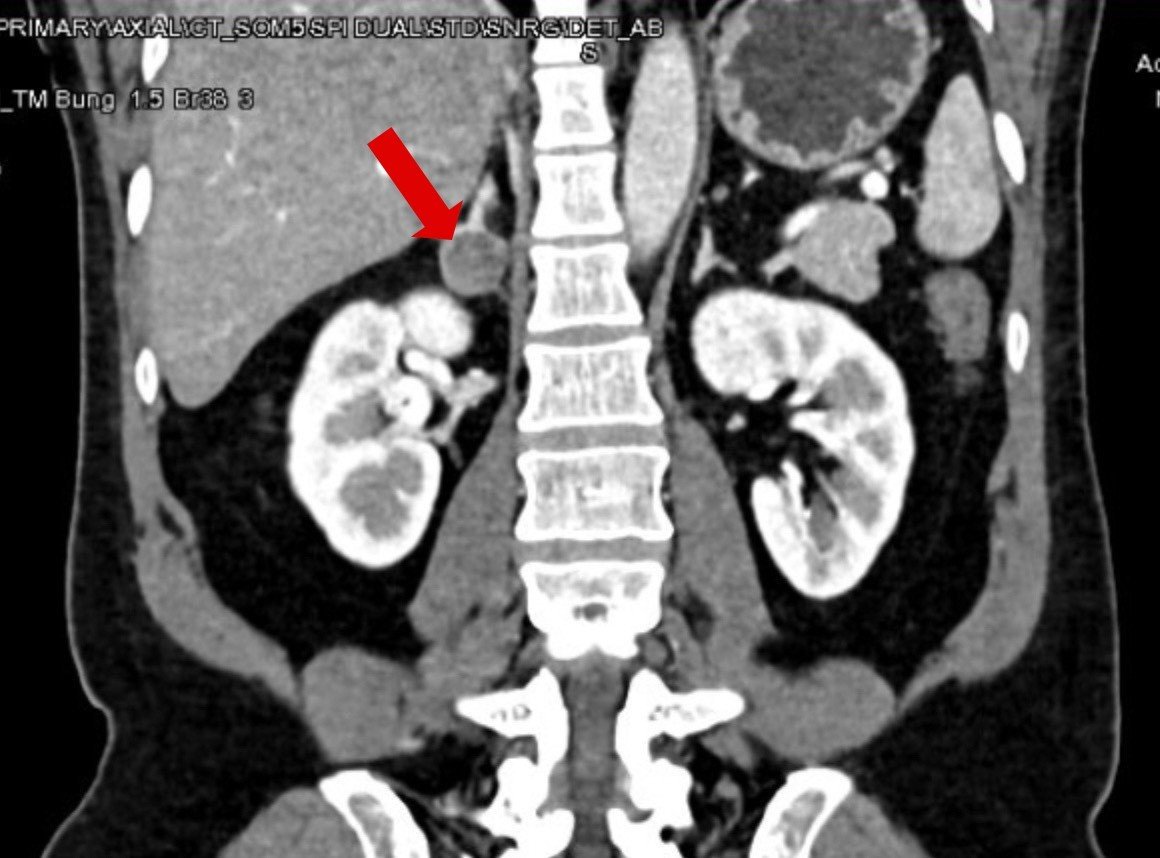 腫瘍のせいで患者は高血圧になり、2年間カリウムサプリメントを服用しなければならなかった。画像2