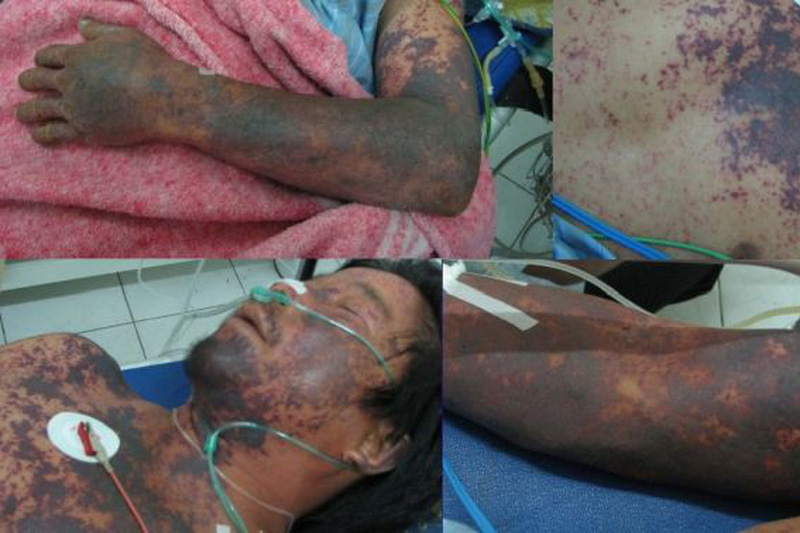 Hospitalizado por comer morcilla grande con bacteria estreptococo ¿qué tan peligroso es? foto 1