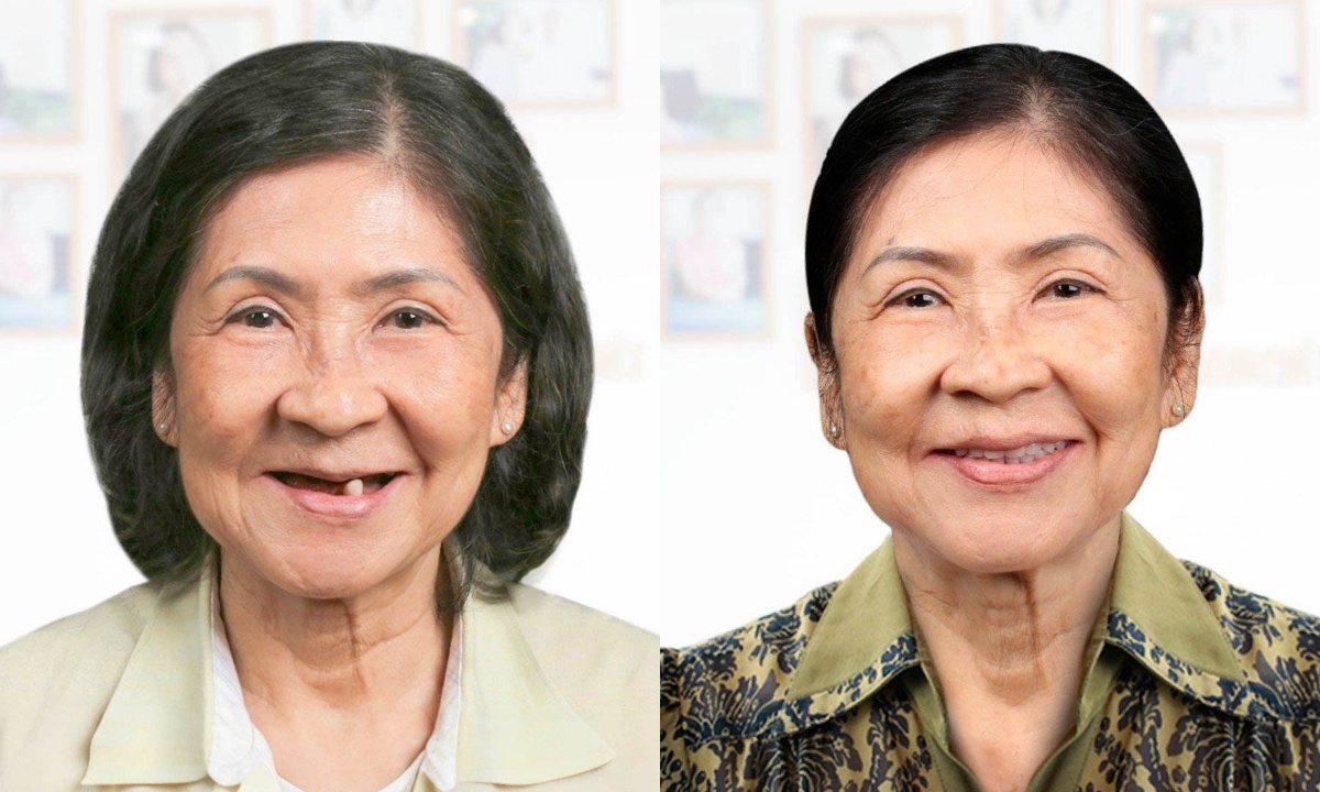 4 highlights when getting implants at Dr. Care