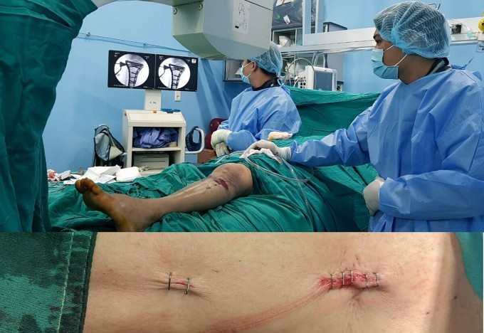 ด้วยความช่วยเหลือของระบบ C-Arm (ภาพด้านบน) แพทย์สามารถวางเครื่องมือผ่านแผลผ่าตัดที่เล็กมากได้ (ภาพด้านล่าง) ภาพ : จัดทำโดยคุณหมอ
