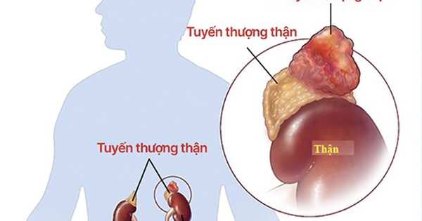 Trẻ bị cao huyết áp do bệnh hiếm