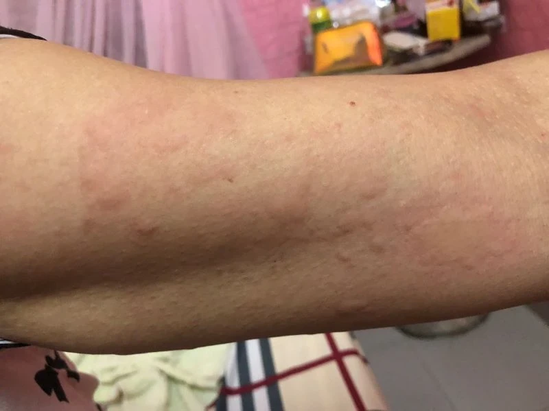 Cómo prevenir la aparición de urticaria en invierno