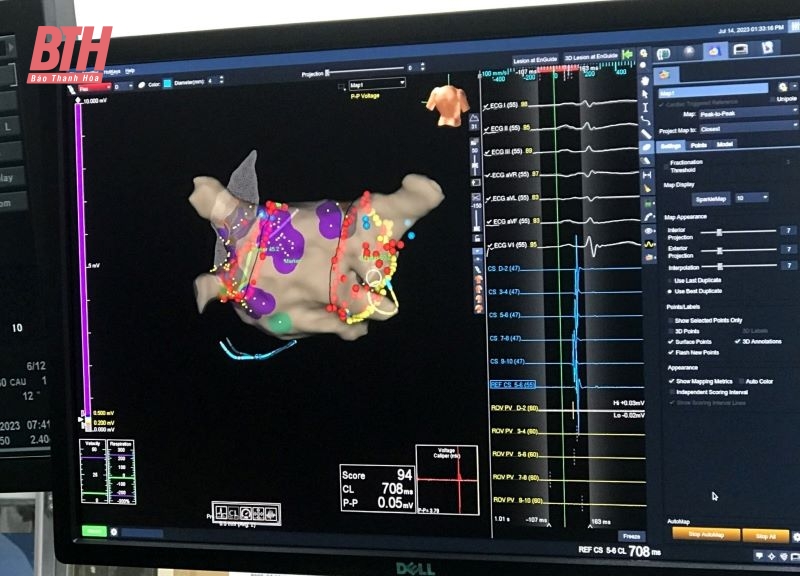 The first provincial hospital successfully implemented radiofrequency ablation for atrial fibrillation using a 3D mapping system