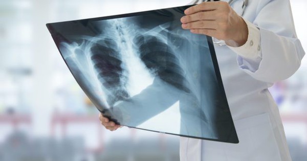 La tomografía computarizada de tórax de baja dosis ayuda a detectar el cáncer de pulmón de forma temprana