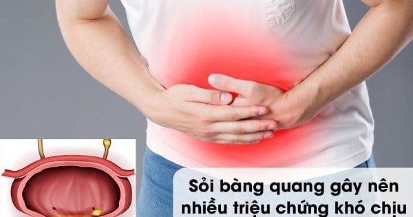 Người đàn ông 49 tuổi ở Phú Thọ nguy cơ suy thận do sỏi bàng quang gây tắc nghẽn đường tiểu