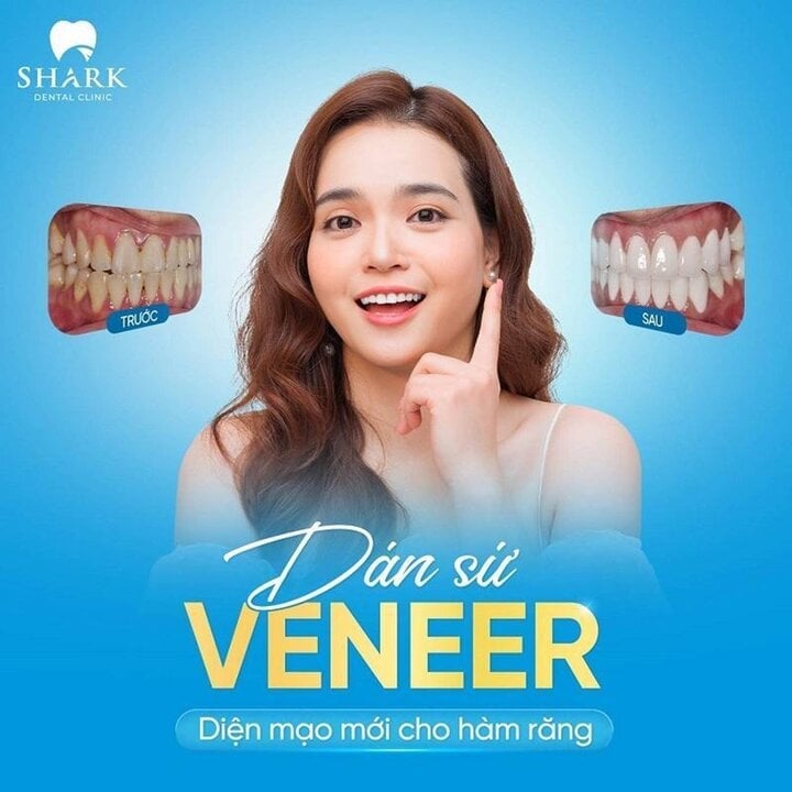 Dán sứ Veneer với giá ưu đãi tại Nha Khoa Shark.