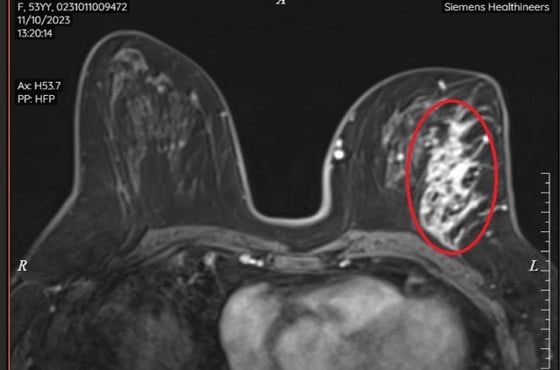 MRI sau tiêm thuốc có hình ảnh tổn thương không tạo khối, ngấm thuốc mạnh 1/4 trên ngoài vú trái. ảnh 2