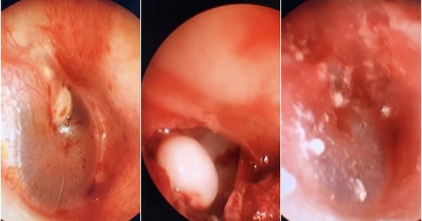 Lấy khối u như hạt ngọc trai ra khỏi tai bé trai 5 tuổi