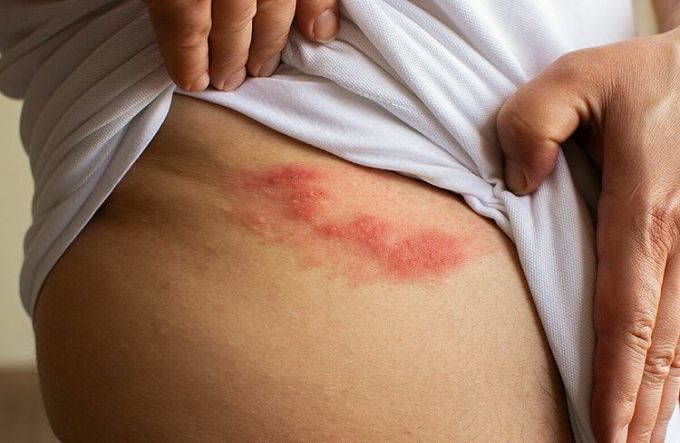 Shingles can cause persistent, long-lasting pain. Photo: CNN