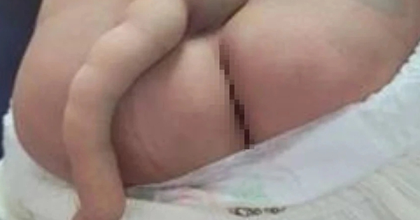 Un bebé de 4 meses tiene una 'cola' de 14 cm de largo