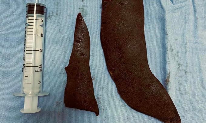 Der melanozytäre Nävus wurde entfernt. Foto: Zur Verfügung gestellt vom Krankenhaus