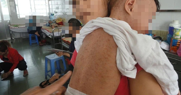 Many children get measles because parents 'forget' to vaccinate their children